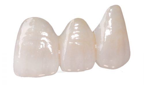 IPS-emax-veneer-wh